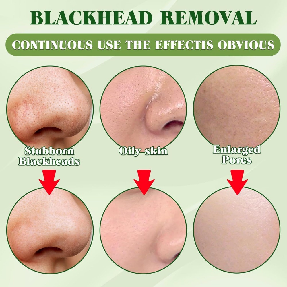 15 Pack Charcoal Blackhead Rem - đánh giá và giá Charcoal Pore Strip